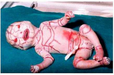 Bayi dengan jenis ichthyosis Harlequin